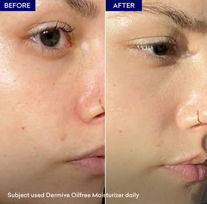 Dermive Oil Free Calms & Soothes | Light-Weight